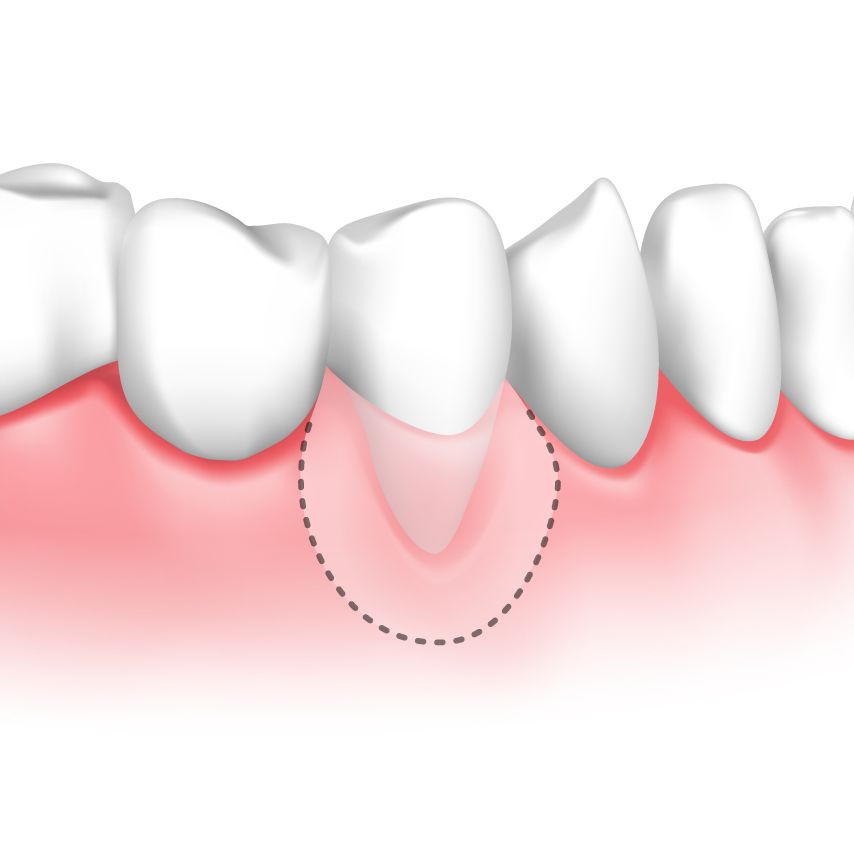Illustration of a gum after a gum graft