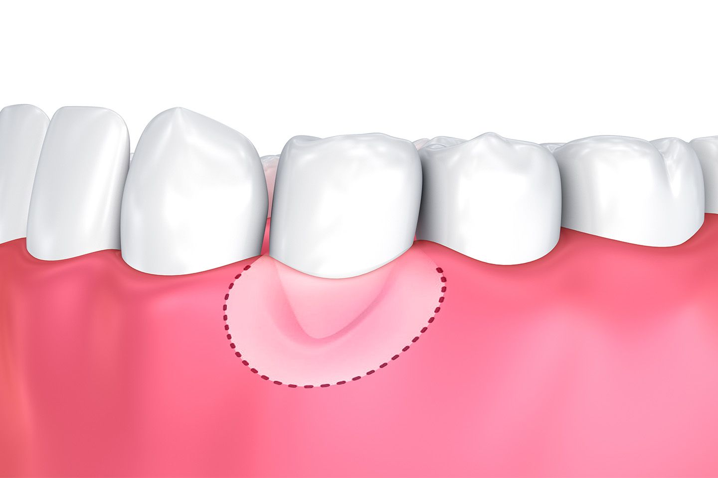 Illustration of gum graft